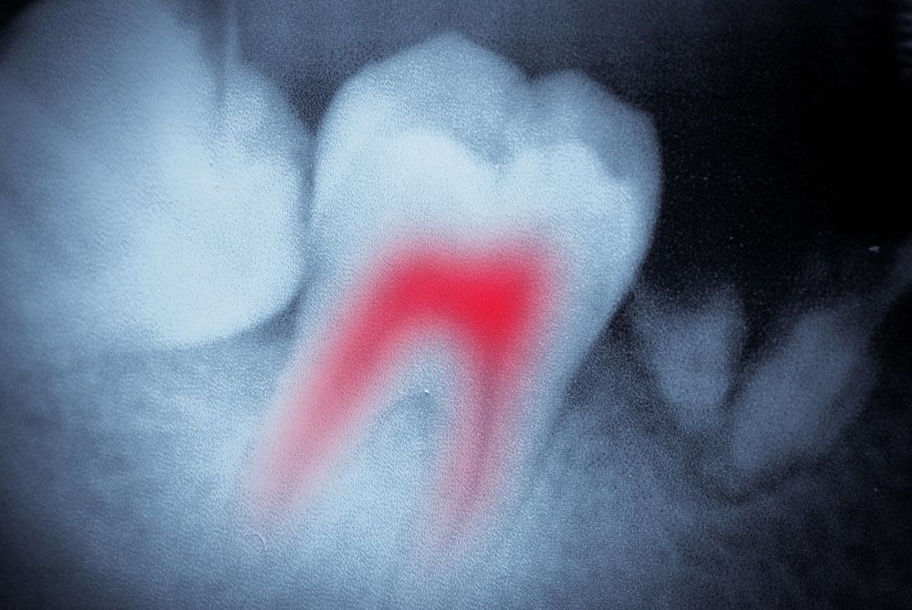 X-ray showing inflamed tooth root